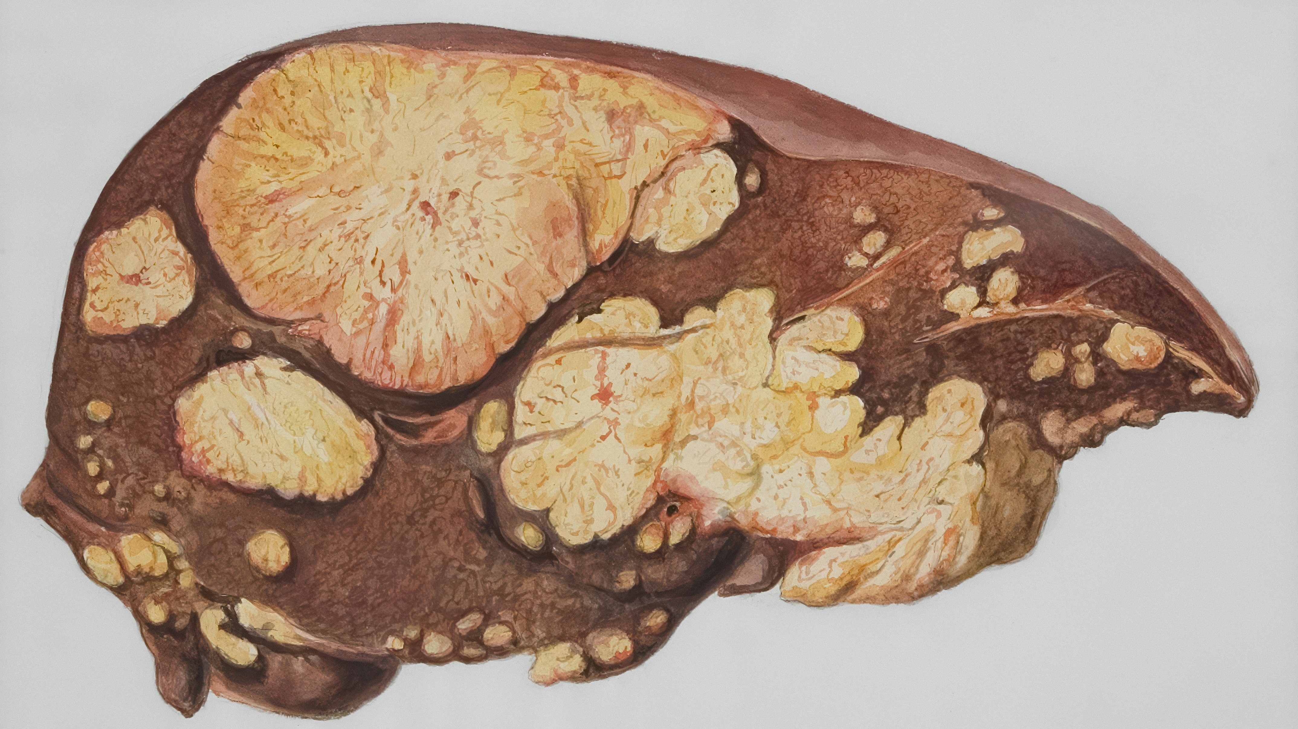 Shilpa wins SEC–CDSCO nod to market fatty liver drug in India