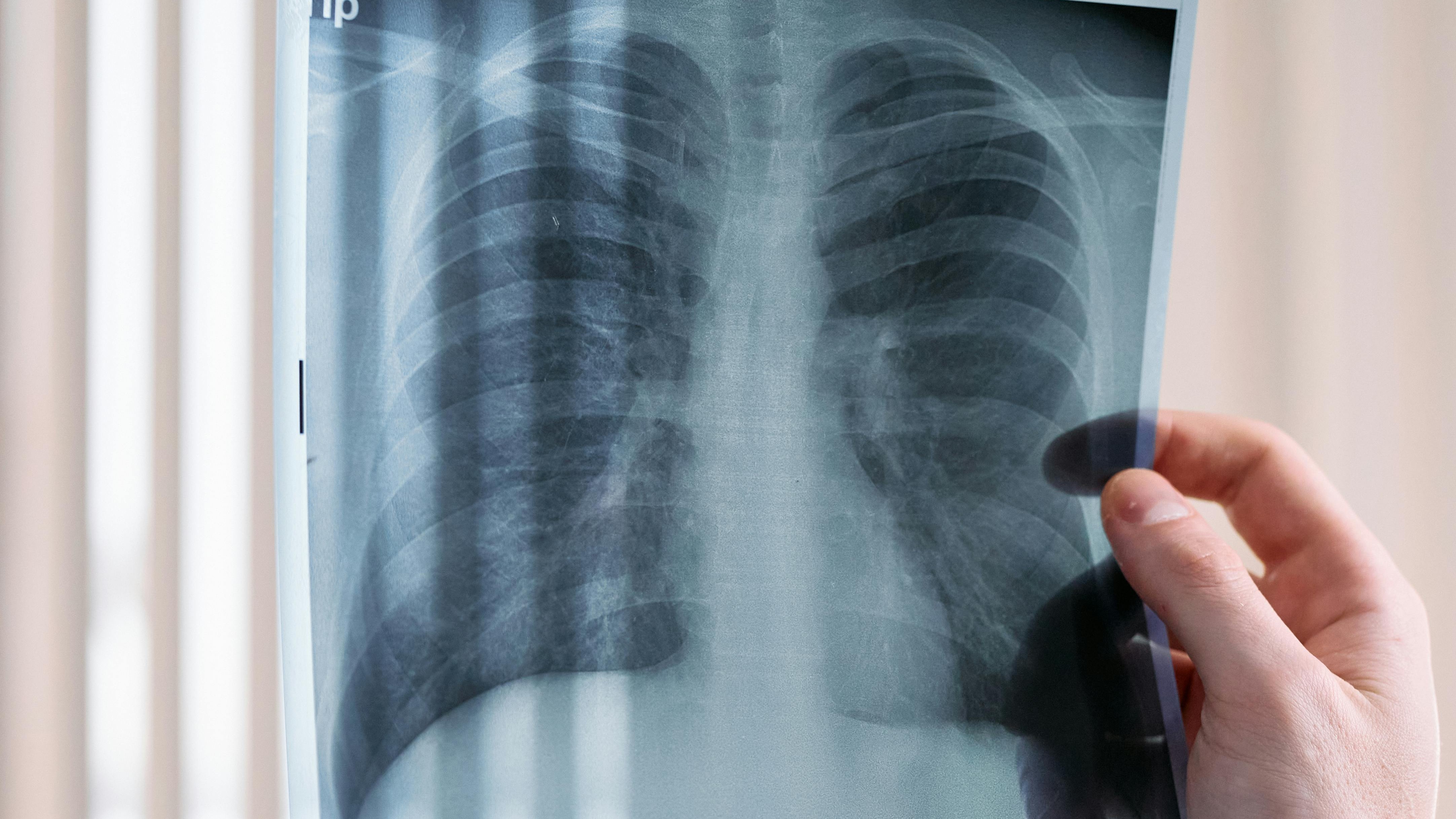 PureTech’s deupirfenidone: Overcoming the efficacy paradigm in IPF